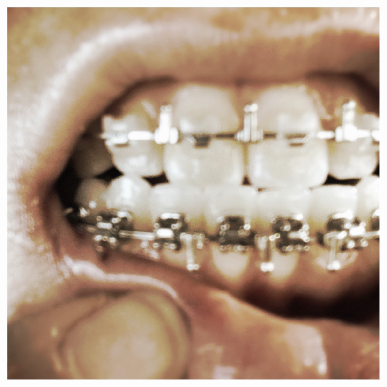 TMJD, Braces, and Double Jaw Surgery Fun! T5 Hooks!